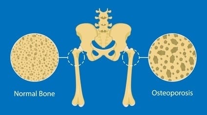 MMA Metabolism Weakened Bones