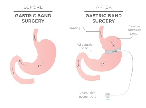 Gastric Band Surgery | Fighting Arts Health Lab