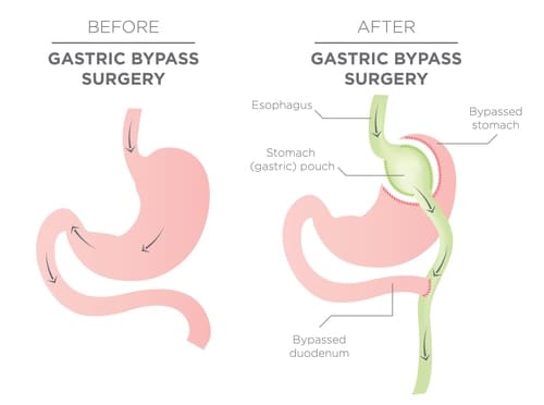 Gastric Bypass Surgery | Fighting Arts Health Lab