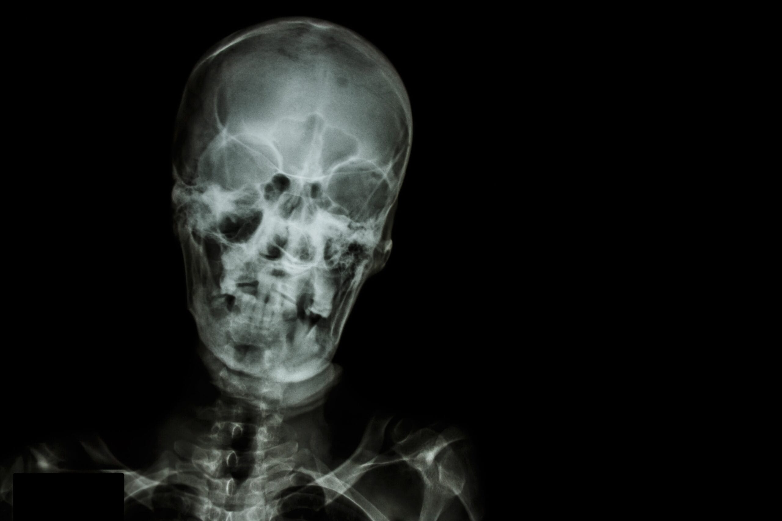 Head Injury XRay | Fighting Arts Health Lab