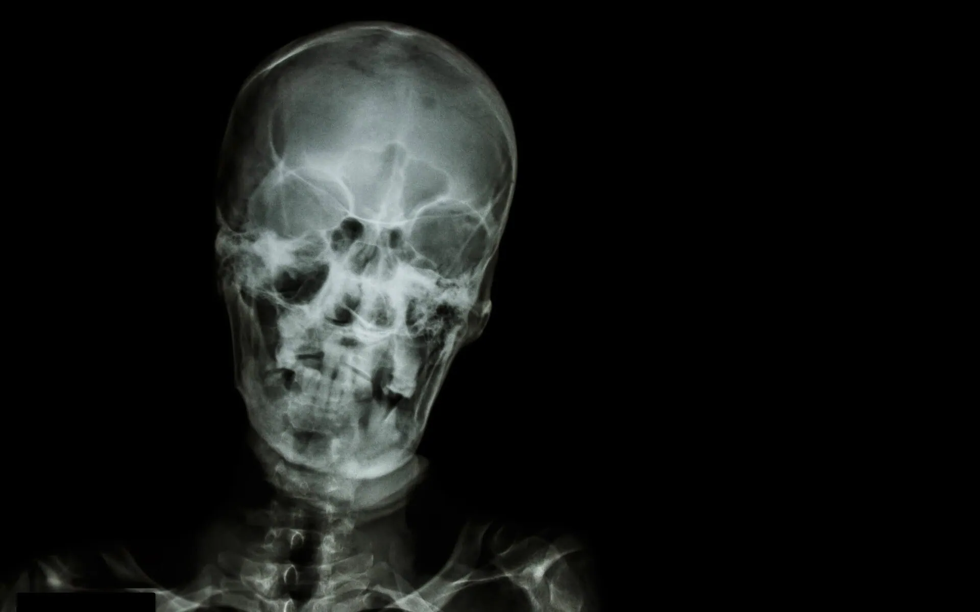 Head Injury XRay | Fighting Arts Health Lab