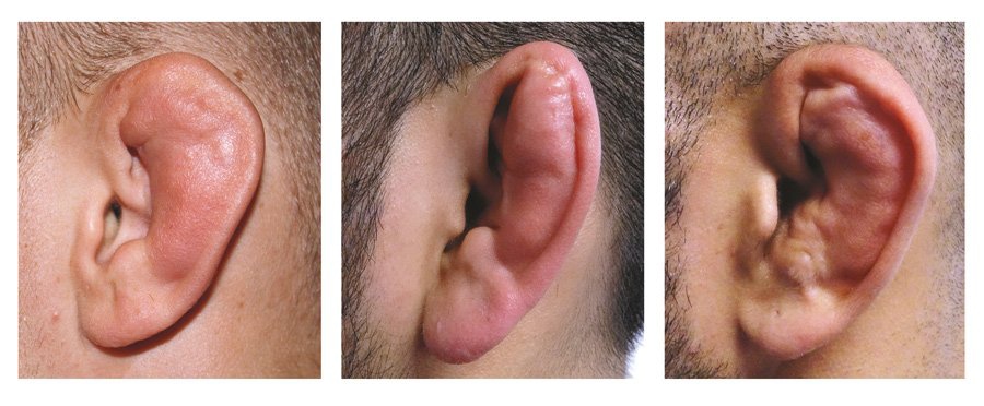 Cauliflower Ear Auricular Hematoma  | Fighting Arts Health Lab