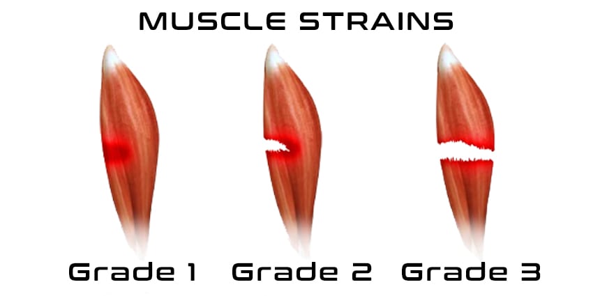 Grades of Muscle Injury | Fighting Arts Health Lab