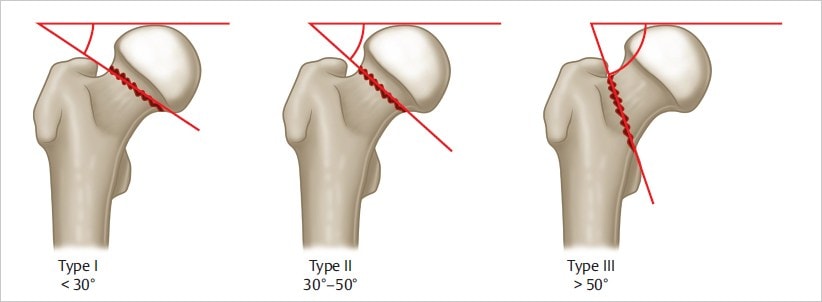 Combat Arts Thigh Injuries Pauwel Classification | Fighting Arts Health Lab