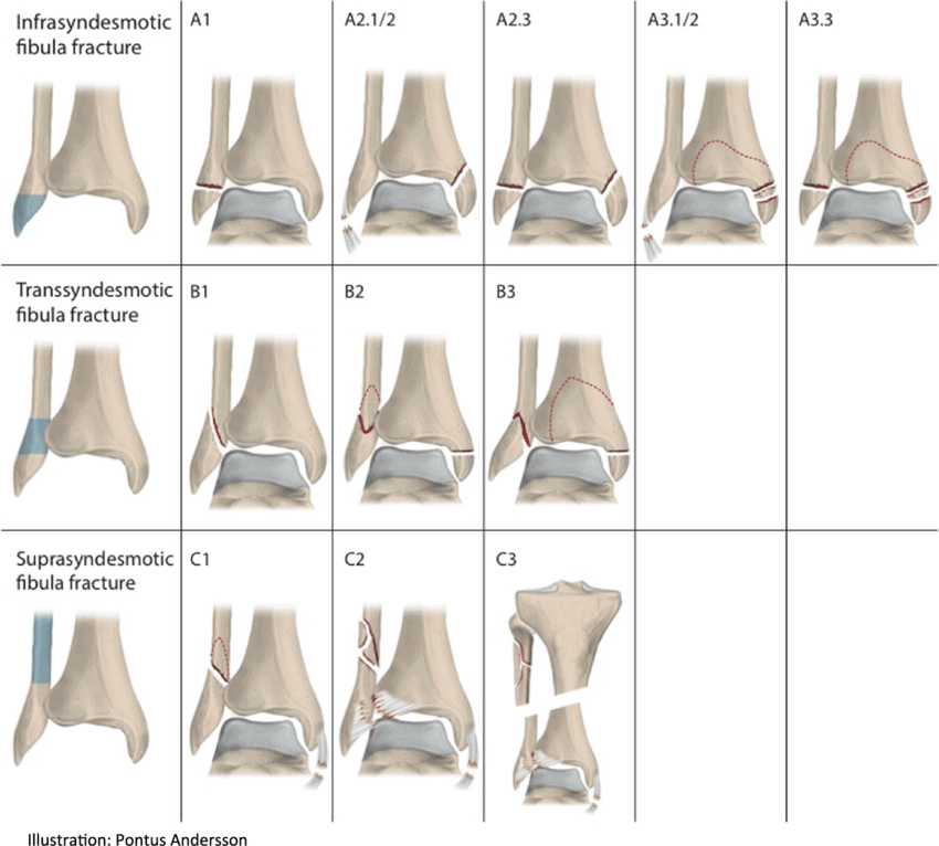 Combat Arts Thigh Injuries AO OTA Fractures Classification | Fighting Arts Health Lab