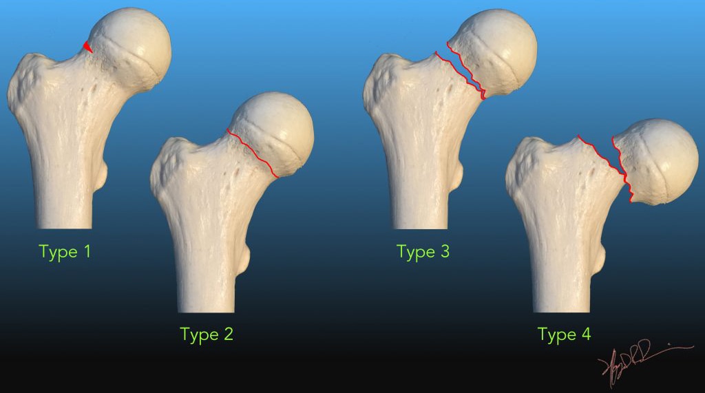 Combat Arts Thigh Injuries Garden Fracture Classifications | Fighting Arts Health Lab