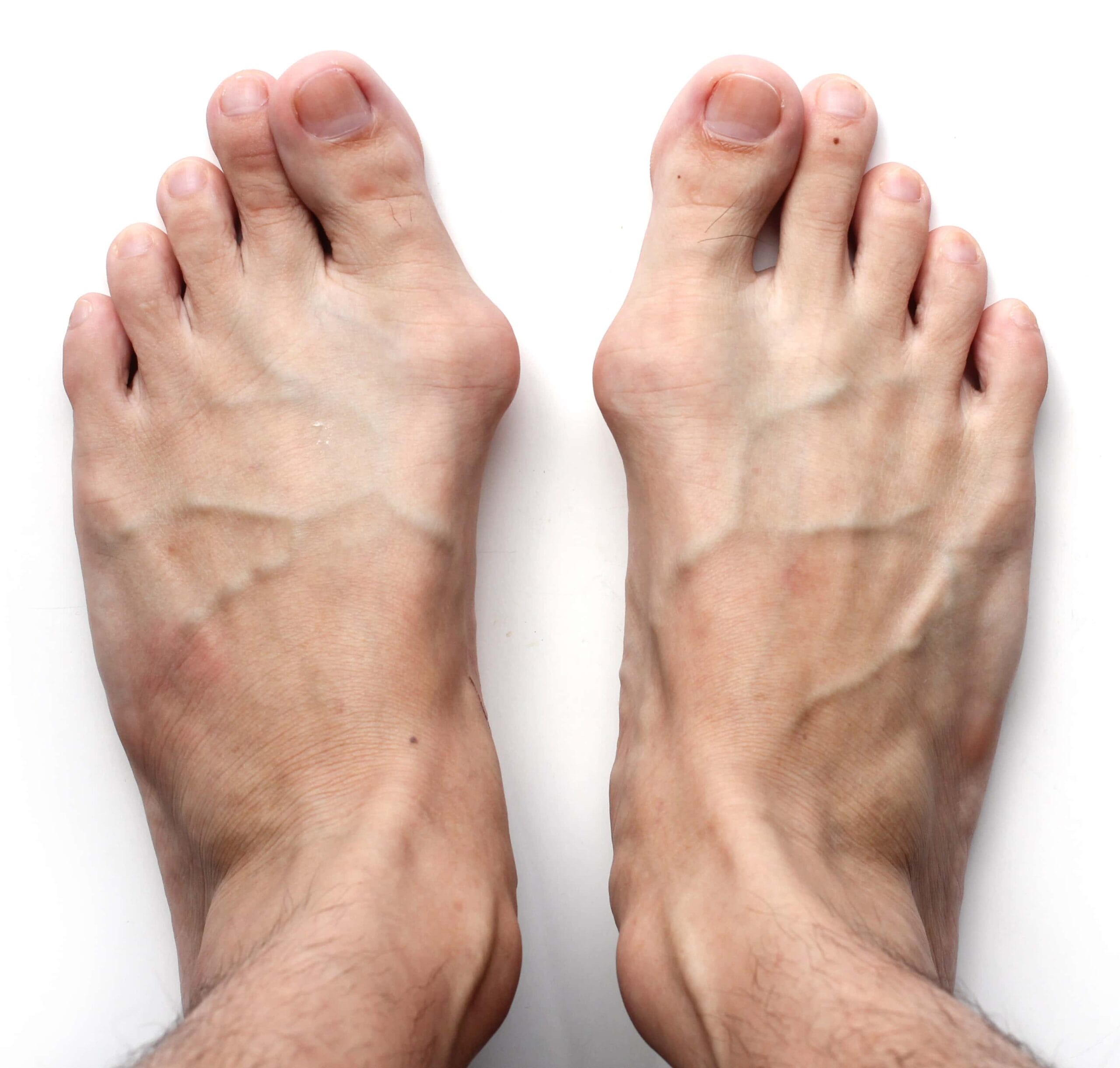 Bunions Mans Feet | Fighting Arts Health Lab