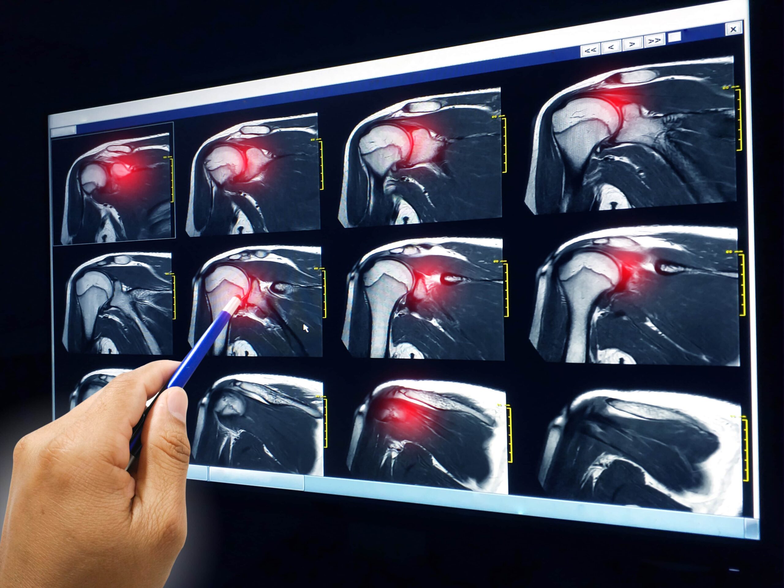 Rotator Cuff Injury XRay | Fighting Arts Health Lab